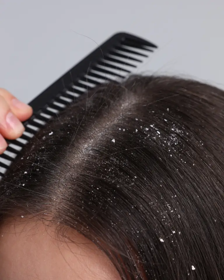 Remove Dandruff From Hair